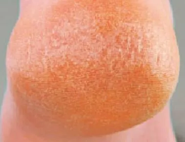 Callous Remover